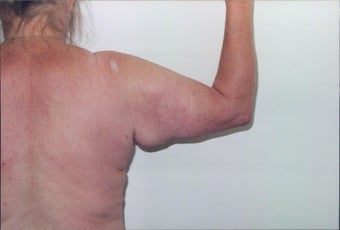 Arm lift