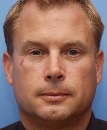 Cheek Dermafiller, Under Eye Dermafiller