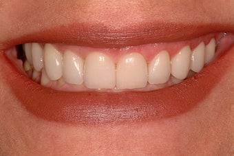 Porcelain Veneers