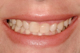 Porcelain Veneers