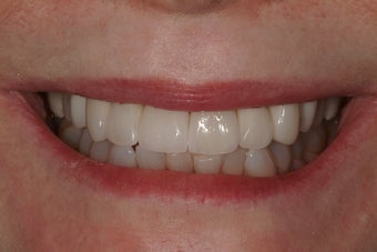 Full Mouth Reconstruction