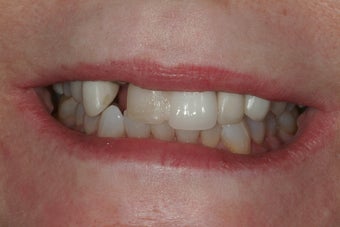 Full Mouth Reconstruction