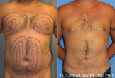 Male Breast Reduction