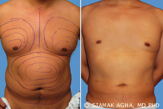Male Breast Reduction