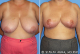 Breast Reduction