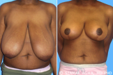 Breast Reduction