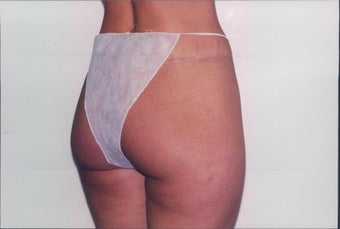 Body Lift