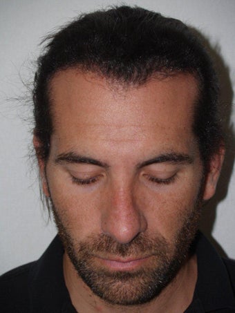 Hair Transplant and Rhinoplasty