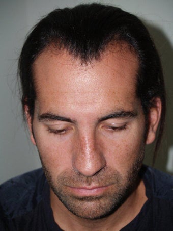 Hair Transplant and Rhinoplasty