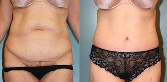 Tummy Tuck