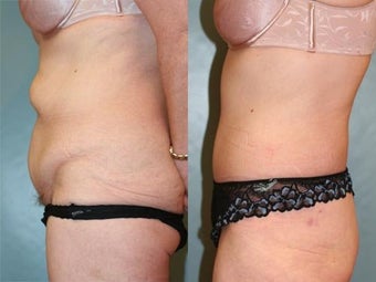 Tummy Tuck