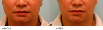 Botox Jaw Reduction