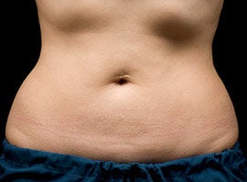 CoolSculpting Procedure with Zeltiq Machine