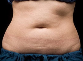 CoolSculpting Procedure with Zeltiq Machine