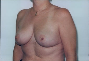 Breast Reduction