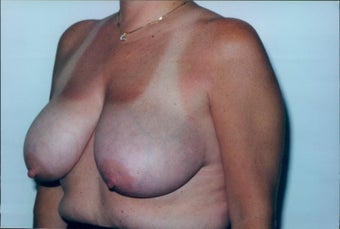 Breast Reduction