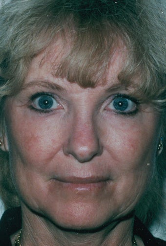 Laser Resurfacing