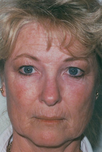 Laser Resurfacing