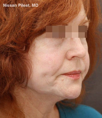 Sculptra for Facial Volume Restoration