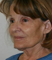 blepharoplasty (eyelids)