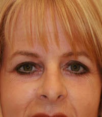 blepharoplasty (eyelids)