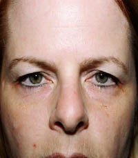 blepharoplasty (eyelids)