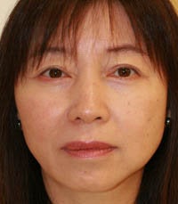 blepharoplasty (eyelids)