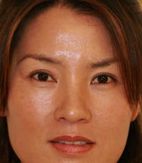 blepharoplasty (eyelids)