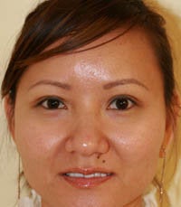 blepharoplasty (eyelids)