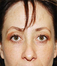 blepharoplasty (eyelids)