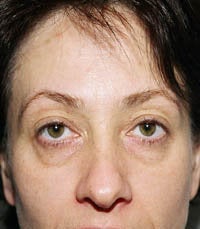blepharoplasty (eyelids)