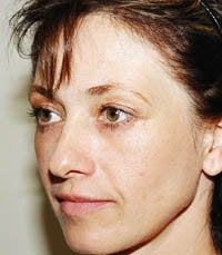 blepharoplasty (eyelids)