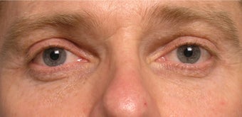 Restylane upper eyelid hollows