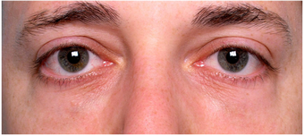 Restylane to lower eyelid hollows
