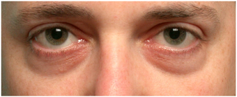 Restylane to lower eyelid hollows