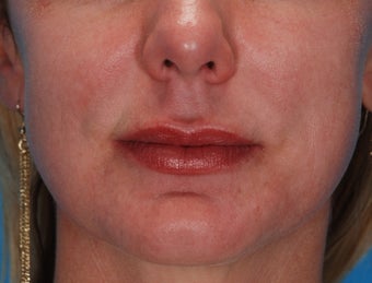 Lip Augmentation with Juvederm