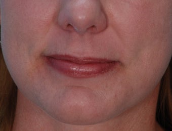 Lip Augmentation with Juvederm