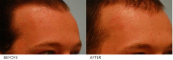 Scar Revision