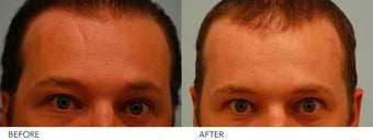 Scar Revision