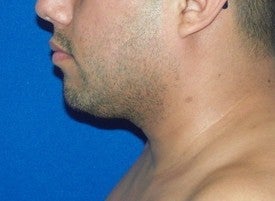 Laser Liposuction