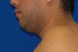 Laser Liposuction