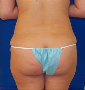Laser Liposuction