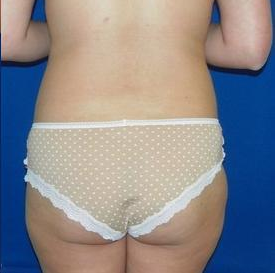 Laser Liposuction