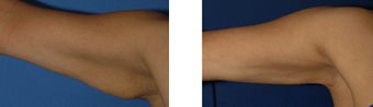 Arm lift