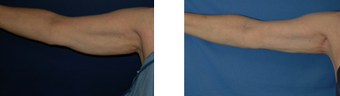 Arm lift