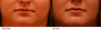 Lip Augmentation