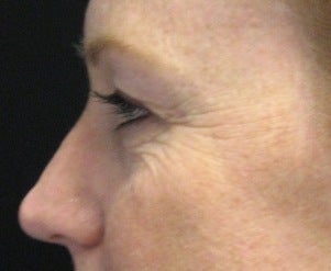 Fraxel CO2 Laser Resurfacing