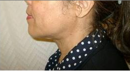 Laser Liposuction