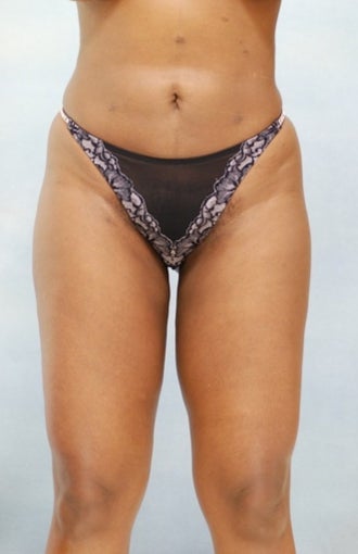 Liposuction