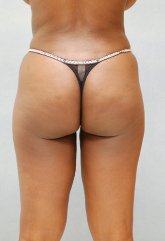 Liposuction